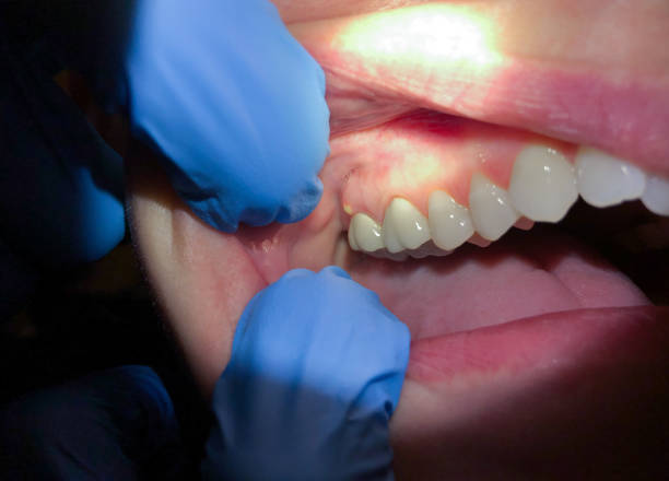 Best Emergency Treatment for Dental Infections or Abscesses in Amherst, TX